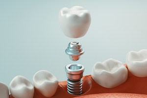 A model showing the three parts of a dental implant on a table