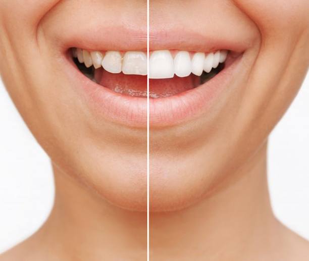 Before and after veneers