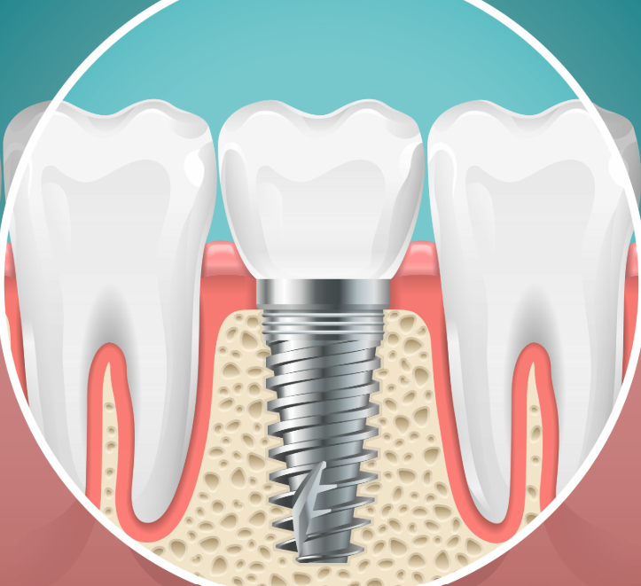 Illustrated dental implant cross section