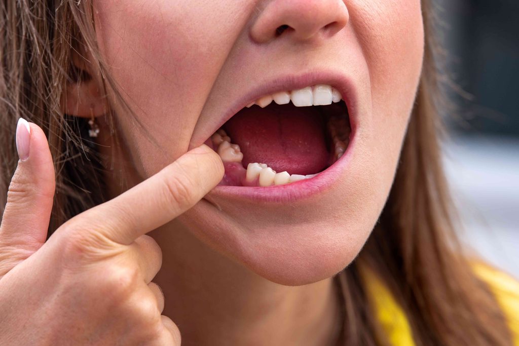 Woman missing a tooth