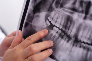 Fingers pointing to gap left by missing tooth on X-ray image